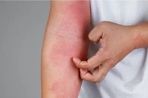 Cuidados para la dermatitis atópica